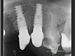 X-ray - custom abutments